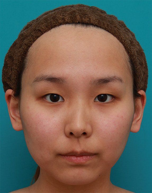 症例写真,二重まぶた埋没法で幅が広すぎない自然な二重を作った10代の女の子の症例写真,Before,ba_maibotsu50_b.jpg