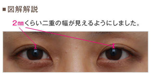 切開二重後のぷっくりと睫毛の生え際について Dr 高須幹弥の美容整形講座 美容整形の高須クリニック
