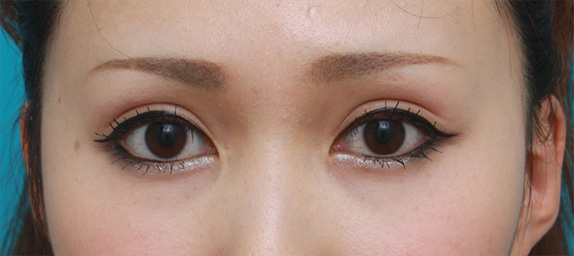 症例写真,もともと狭い末広型二重の人にミニ切開二重を行い幅広平行二重にした症例写真,After(メイクあり),