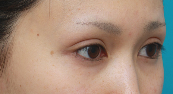 症例写真,もともと狭い末広型二重の人にミニ切開二重を行い幅広平行二重にした症例写真,After(メイクなし),ba_minisekkai27b_b.jpg