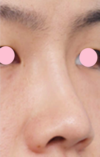 症例写真,隆鼻術（シリコンプロテーゼ）,1週間後,mainpic_ryubi3c.jpg