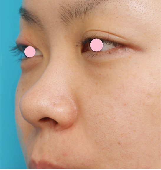 症例写真,隆鼻術（シリコンプロテーゼ）の症例 鼻先が上に向いたブタ鼻のように見えていた20代女性,手術前,mainpic_ryubi04a.jpg