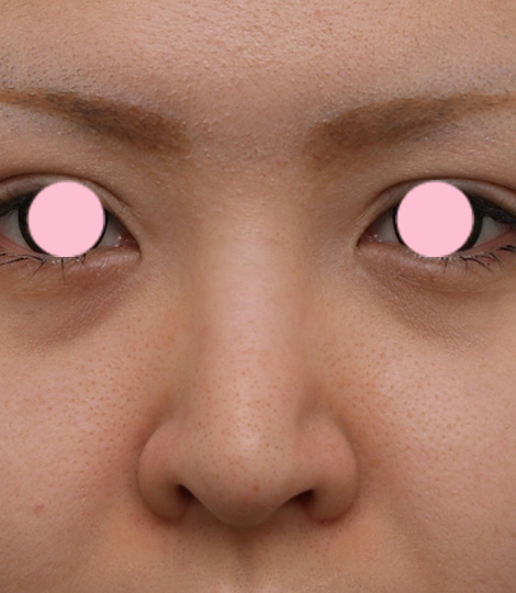 隆鼻術（シリコンプロテーゼ）,3mmの鼻シリコンプロテーゼを入れた症例写真,Before,ba_ryubi32_b.jpg