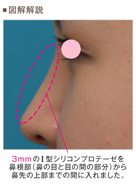 鼻叩きで本当に鼻は高くなるのか 効果はあるのか Dr 高須幹弥の美容整形講座 美容整形の高須クリニック