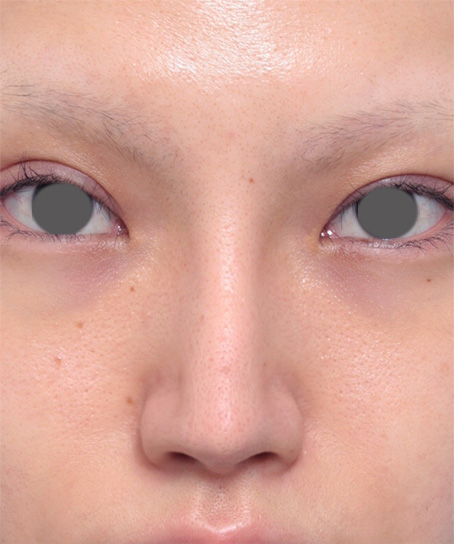 症例写真,鼻にヒアルロン酸が入っている方に、プロテーゼ+耳介軟骨移植+鼻翼縮小を行った症例写真,After（メイクなし）,ba_ryubi40_b.jpg