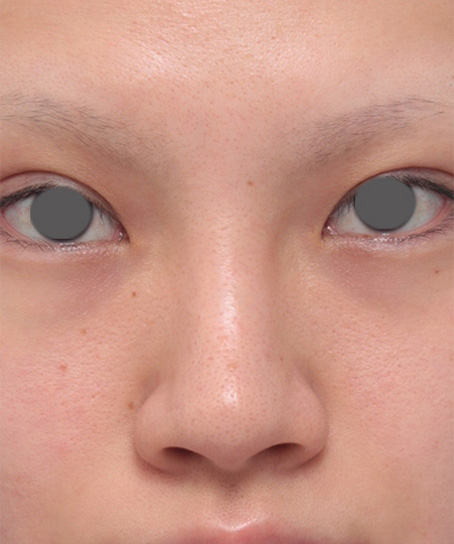 症例写真,鼻にヒアルロン酸が入っている方に、プロテーゼ+耳介軟骨移植+鼻翼縮小を行った症例写真,Before,ba_ryubi40_b.jpg