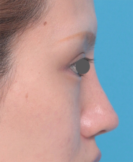 症例写真,鼻にヒアルロン酸が入っている方に、プロテーゼ+耳介軟骨移植+鼻翼縮小を行った症例写真,After（メイクあり）,