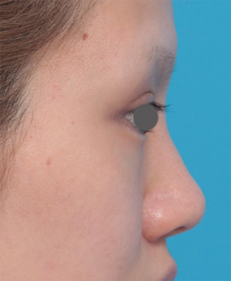 耳介軟骨移植（鼻先を出す）,鼻にヒアルロン酸が入っている方に、プロテーゼ+耳介軟骨移植+鼻翼縮小を行った症例写真,Before,ba_ryubi42_b.jpg