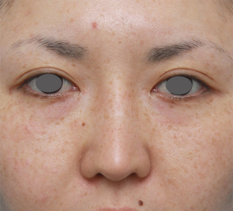 症例写真,鼻シリコンプロテーゼ+鼻先の耳介軟骨移植症例写真,After（3ヶ月後）,ba_ryubi48_b.jpg