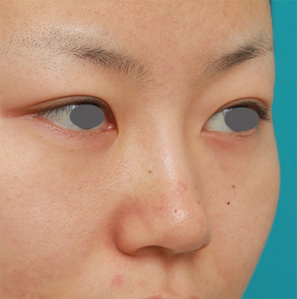 症例写真,鼻のシリコンプロテーゼ+鼻翼（小鼻）縮小手術の症例写真,After（6ヶ月後）,ba_ryubi56_b.jpg