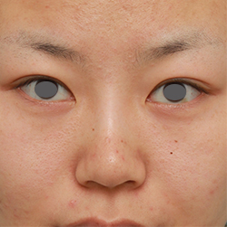 症例写真,鼻のシリコンプロテーゼ+鼻翼（小鼻）縮小手術の症例写真,6ヶ月後,mainpic_ryubi14e.jpg