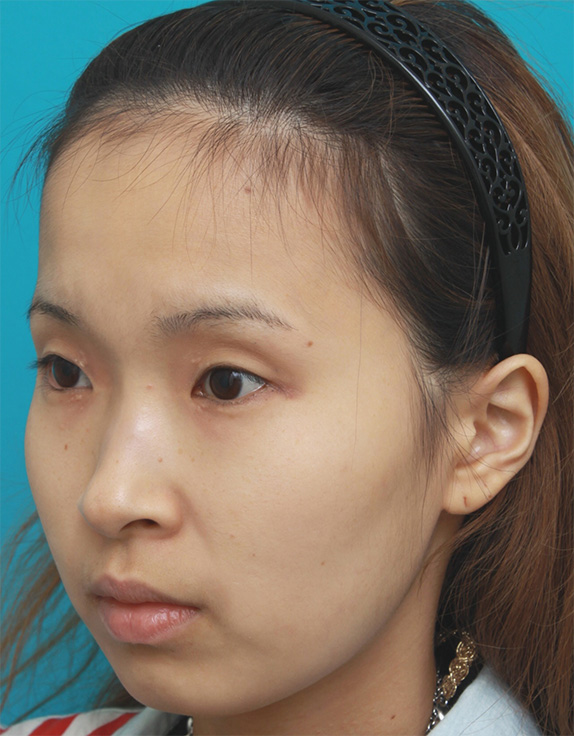 症例写真,眉間~鼻根~鼻背にかけてシリコンプロテーゼを入れ、鼻筋を通して高くした症例写真の画像,Before,ba_ryubi60_b.jpg