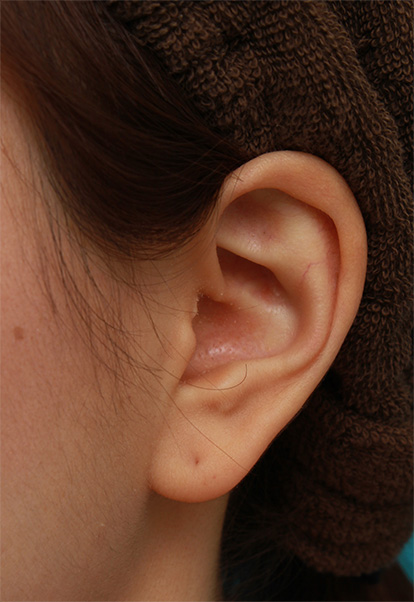 耳介軟骨移植（鼻先を出す）,鼻に注入されたヒアルロン酸をヒアルロニダーゼで溶かすのと同時にシリコンプロテーゼ+耳介軟骨移植をした症例写真の術前術後画像,After（6ヶ月後）,ba_ryubi66_b.jpg
