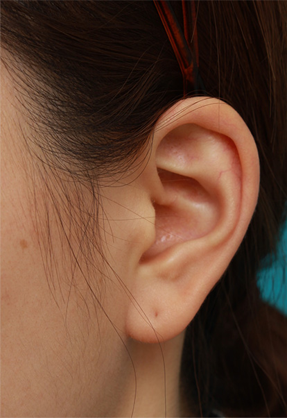 耳介軟骨移植（鼻先を出す）,鼻に注入されたヒアルロン酸をヒアルロニダーゼで溶かすのと同時にシリコンプロテーゼ+耳介軟骨移植をした症例写真の術前術後画像,Before,ba_ryubi66_b.jpg