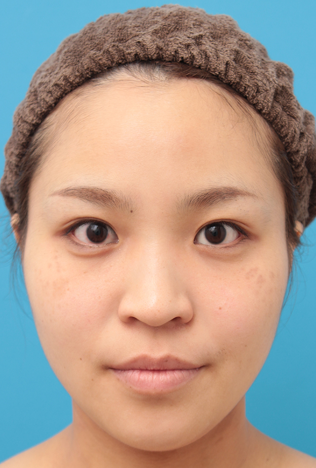 症例写真,鼻に3mmのシリコンプロテーゼを入れ、自然に鼻筋を通した症例写真,手術前,mainpic_ryubi16a.jpg