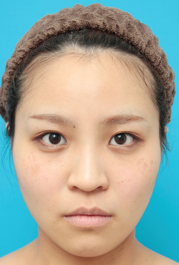 症例写真,鼻に3mmのシリコンプロテーゼを入れ、自然に鼻筋を通した症例写真,6ヶ月後,mainpic_ryubi16d.jpg