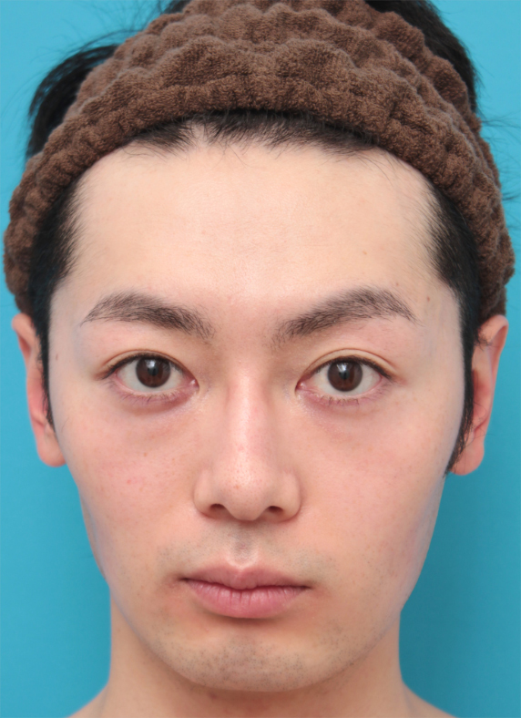 眉間~鼻筋にかけてのシリコンプロテーゼ+ボツリヌストキシン注射（エラ、プチ小顔術）をした20代男性の症例写真,After（6ヶ月後）,ba_ryubi70_a01.jpg
