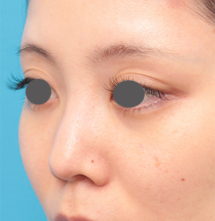 症例写真,鼻のヒアルロン酸を分解して、同時にシリコンプロテーゼと小鼻縮小をした症例写真の術前術後画像,手術前,mainpic_ryubi17f.jpg