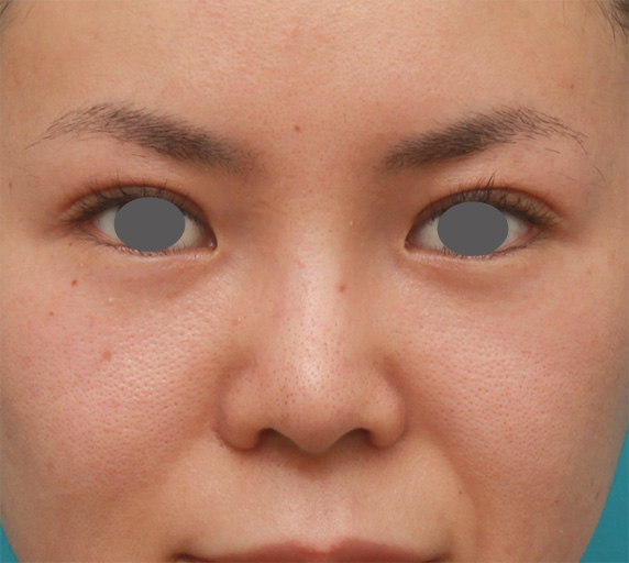 症例写真,鼻のシリコンプロテーゼと小鼻（鼻翼）縮小手術をした20代女性の症例写真,After（6ヶ月後）,ba_ryubi74_b.jpg
