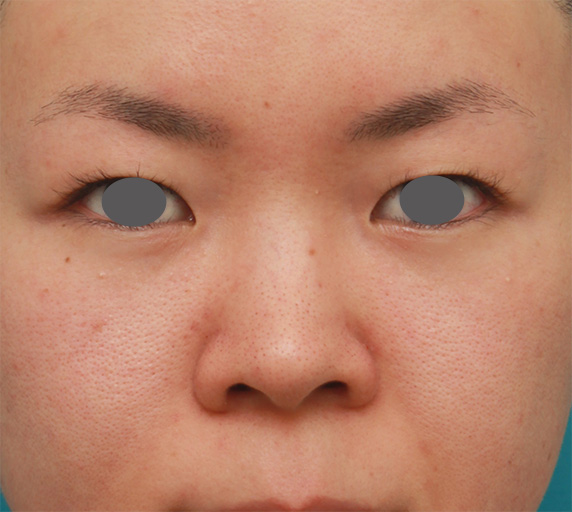 症例写真,鼻のシリコンプロテーゼと小鼻（鼻翼）縮小手術をした20代女性の症例写真,Before,ba_ryubi74_b.jpg
