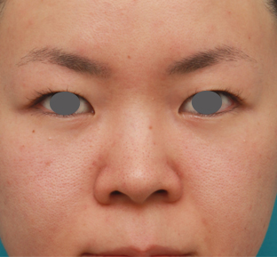 症例写真,鼻のシリコンプロテーゼと小鼻（鼻翼）縮小手術をした20代女性の症例写真,手術前,mainpic_ryubi18a.jpg