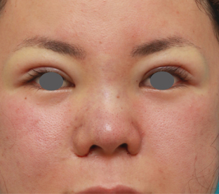 症例写真,鼻のシリコンプロテーゼと小鼻（鼻翼）縮小手術をした20代女性の症例写真,手術直後,mainpic_ryubi18b.jpg
