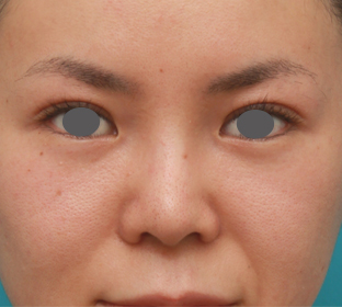 症例写真,鼻のシリコンプロテーゼと小鼻（鼻翼）縮小手術をした20代女性の症例写真,6ヶ月後,mainpic_ryubi18d.jpg