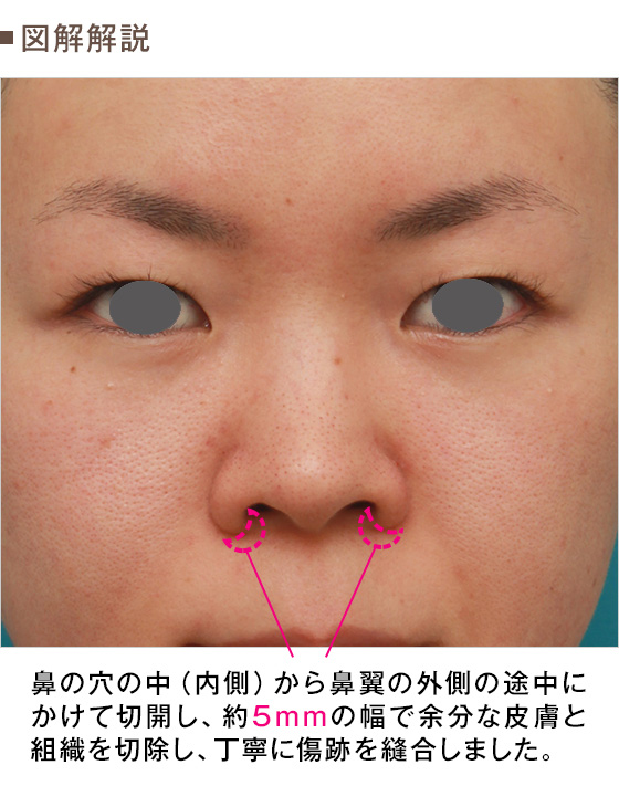 鼻のシリコンプロテーゼと小鼻 鼻翼 縮小手術をした代女性の症例写真 美容整形の高須クリニック 東京赤坂 横浜 名古屋 大阪