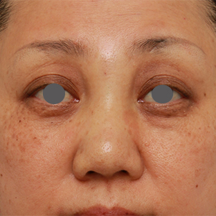 症例写真,40代後半女性の低い鼻にシリコンプロテーゼを入れて高くした症例写真の術前術後画像,手術直後,mainpic_ryubi19b.jpg
