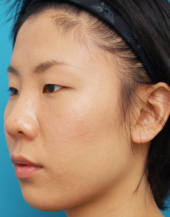 隆鼻注射（ヒアルロン酸注射）の症例 目と目の間がくぼんでいた20代女性,After（1週間後）,ba_ryubichusha18_a01.jpg