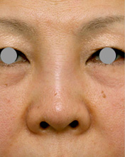 他院で安価なヒアルロン酸を鼻に注射してアバターのようになった方の修正症例写真,Before施術前,ba_ryubichusha23_b.jpg