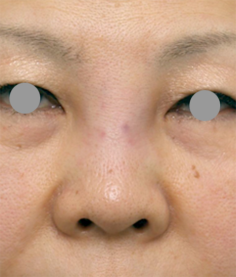 症例写真,他院で安価なヒアルロン酸を鼻に注射してアバターのようになった方の修正症例写真,ヒアルロニダーゼ注射直後,mainpic_ryubi7b.jpg