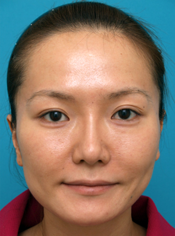 隆鼻注射（ヒアルロン酸注射）の症例 鼻と涙袋をプチ整形した20代女性,After,ba_ryubichusha26_a01.jpg