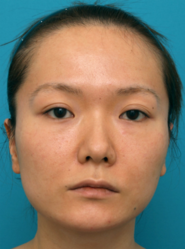 隆鼻注射（ヒアルロン酸注射）の症例 鼻と涙袋をプチ整形した20代女性,Before,ba_ryubichusha26_b.jpg