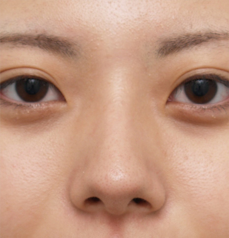 ヒアルロン酸プチ整形で鼻を高くして鼻筋を通した症例写真,After,ba_ryubi50_a01.jpg