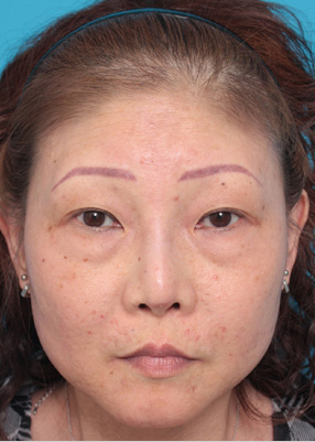 隆鼻注射（ヒアルロン酸注射） 他院治療の修正症例,Before,ba_ryubichusha33_b.jpg