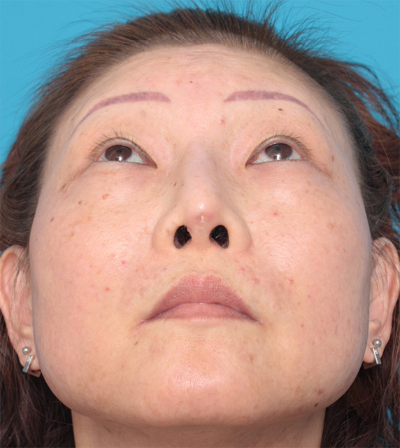 症例写真,隆鼻注射（ヒアルロン酸注射） 他院治療の修正症例,Before,ba_ryubichusha34_b.jpg
