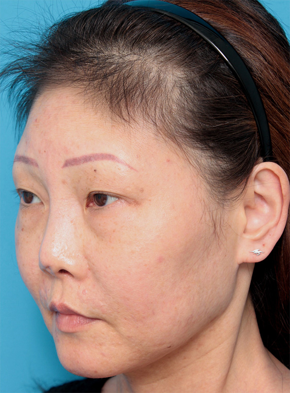 症例写真,隆鼻注射（ヒアルロン酸注射） 他院治療の修正症例,After（ヒアルロン酸注射後1ヶ月）,ba_ryubichusha35_b.jpg