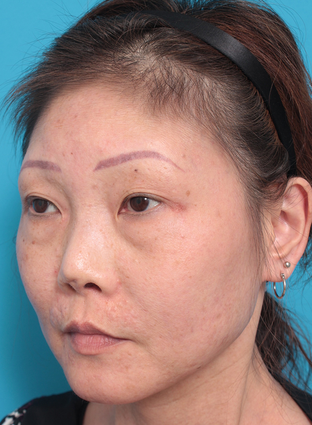症例写真,隆鼻注射（ヒアルロン酸注射） 他院治療の修正症例,2ヶ月後,mainpic_ryubichusha01l.jpg