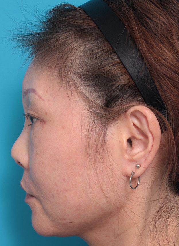 症例写真,隆鼻注射（ヒアルロン酸注射） 他院治療の修正症例,2ヶ月後,mainpic_ryubichusha01o.jpg