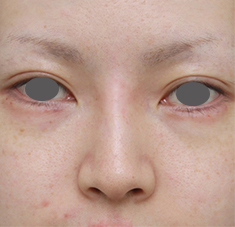 症例写真,長期持続型ヒアルロン酸を注射して鼻を高くし、ワシ鼻を目立たなくした症例写真,注射直後 ,mainpic_ryubi13b.jpg
