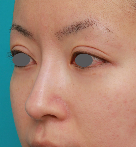 症例写真,長期持続型ヒアルロン酸注射+耳介軟骨移植で鼻筋を通して鼻先を斜め下方向に出した症例写真,After（3ヶ月後）,ba_ryubichusha38_b.jpg