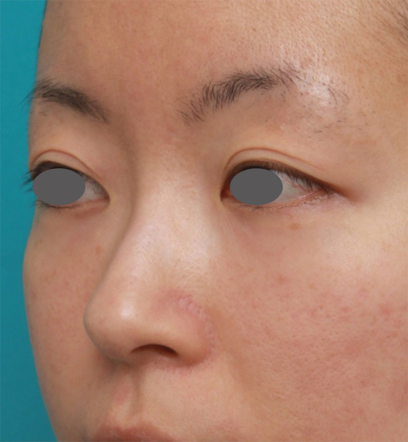 症例写真,長期持続型ヒアルロン酸注射+耳介軟骨移植で鼻筋を通して鼻先を斜め下方向に出した症例写真,Before,ba_ryubichusha38_b.jpg