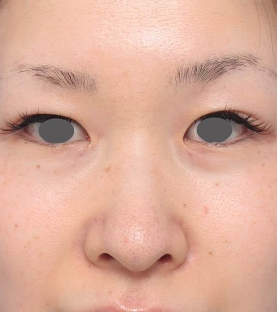 長期持続型ヒアルロン酸注射で鼻を高くして鼻筋を通した症例写真の術前術後画像の解説,Before,ba_ryubichusha42_b.jpg