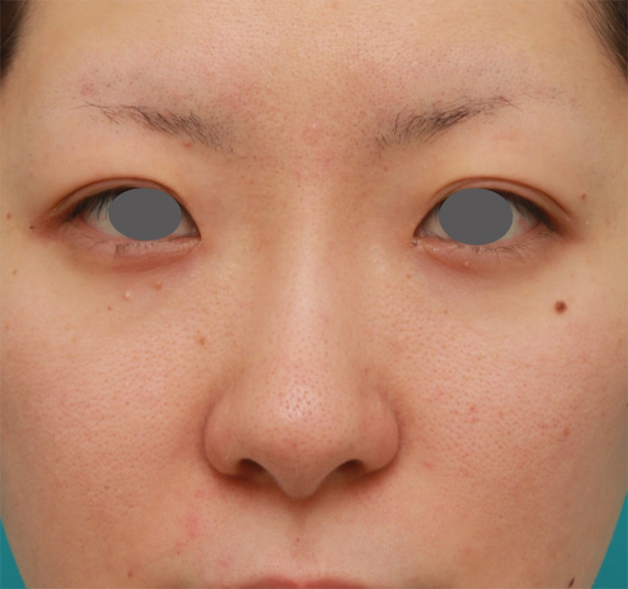 症例写真,長期持続型ヒアルロン酸注射で鼻を高くし、綺麗に鼻筋を通した症例写真,After（1週間後）,ba_ryubichusha44_b.jpg