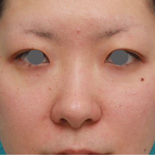 症例写真,長期持続型ヒアルロン酸注射で鼻を高くし、綺麗に鼻筋を通した症例写真,注射前,mainpic_ryubichusha02a.jpg