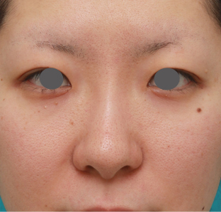 症例写真,長期持続型ヒアルロン酸注射で鼻を高くし、綺麗に鼻筋を通した症例写真,注射翌日,mainpic_ryubichusha02c.jpg