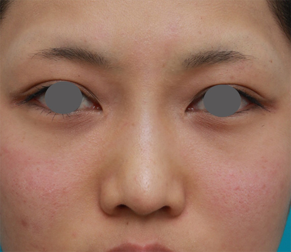 ヒアルロン酸注射と耳介軟骨移植で鼻のバランスを整えた症例写真の術前術後画像,After（2ヶ月後）,ba_ryubichusha46_a01.jpg