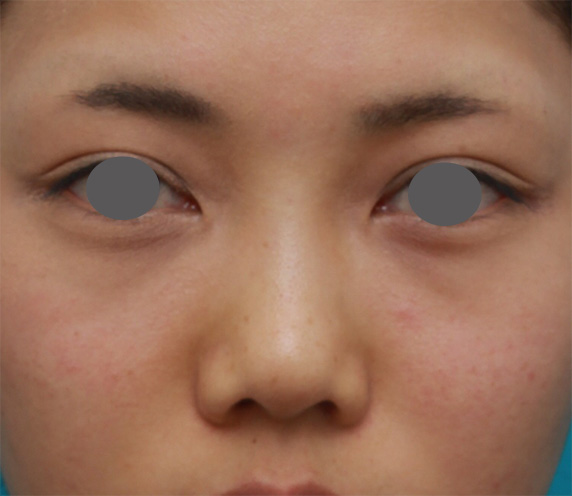 症例写真,ヒアルロン酸注射と耳介軟骨移植で鼻のバランスを整えた症例写真の術前術後画像,Before,ba_ryubichusha46_b.jpg