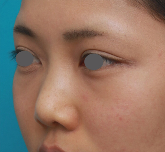 症例写真,ヒアルロン酸注射と耳介軟骨移植で鼻のバランスを整えた症例写真の術前術後画像,Before,ba_ryubichusha47_b.jpg